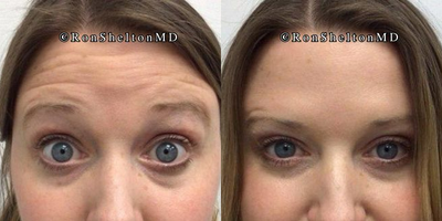 25-34 year old woman treated with Daxxify - 33 year old woman treated with Daxxify for forehead wrinkles. Before and after images taken 'at rest', when 'frowning' and when 'raised'.Note: she doesn't have the lower right forehead crease at rest I did not relax that line so that at rest her right eyebrow is now more symmetric as it was lower than her left eyebrow prior to treatment and if I had relaxed that last crease the right eyebrow would lower.