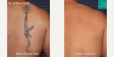 25-34 year old man treated with PicoWay, Tattoo Removal - PicoWay laser used to reduce the appearance of a tattoo on a male patient's back.