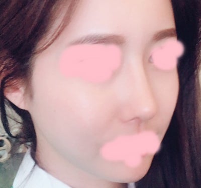 Rhinoplasty Experience In Seoul South Korea Review Realself