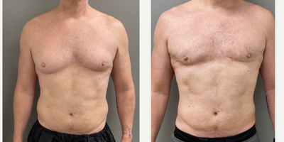 48 year old man treated with Gynecomastia Surgery - 48 yo s/p male breast reduction performed under local anesthesia with sedation performed in our on site AAAA certified operating suite.