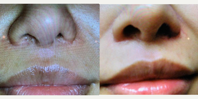 25-34 year old woman treated with Alarplasty - Nostril widening using internal flaps following over-resection performed elsewhere.