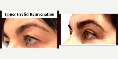 45-54 year old woman treated with Eyelid Surgery - 46 y.o female who was concerned with upper eye hooding underwent upper blepharoplasty under local anesthesia.  At 2 months post-op, her upper eye hooding is gone resulting in rejuvenated appearance.