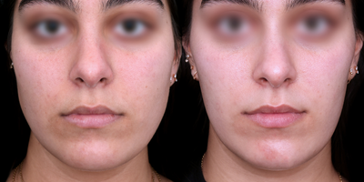 18-24 year old woman treated with Botox for TMJ, Cheek Augmentation - An 18-24 year old Female 3 months post cheek augmentation via neuromodulator injections