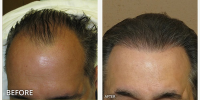 Man treated with Hair Transplant, ARTAS Robotic Hair Transplant - Man treated with Hair Transplant, ARTAS Robotic Hair Transplant