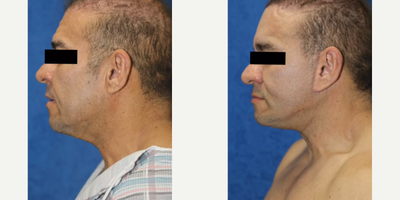 35-44 year old man treated with Brow Lift, Neck Lift, Facelift - This patient in his mid 40s had a brow lift, buccal fat removal, neck lift, and facelift. He disliked his frown lines and wanted a more youthful appearance.