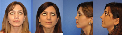 Revision nasal surgery after rhinoplasty for childhood trauma. - This women had a rhinoplasty several years ago to address deformities from a childhood injury.  Unfortunately, she was left with an open roof deformity, irregular dorsal aesthetic lines, insufficient tip support, and residual breathing obstruction.   She underwent an open revision with rib graft.