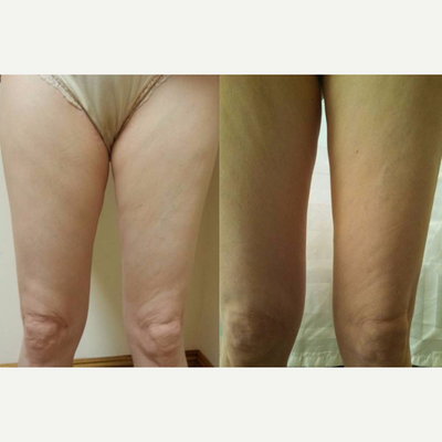 60  year old woman treated with Cellulaze - The back of the thighs below the buttocks and the front of the thighs were treatedOne session one and one half hours duration. Minimal downtime, minor discomfort experienced.Signifcant improvement above the knees.