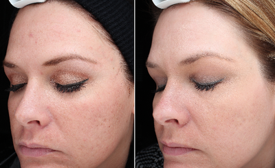45-54 year old woman treated with Halo Laser - After 1 Halo treatment