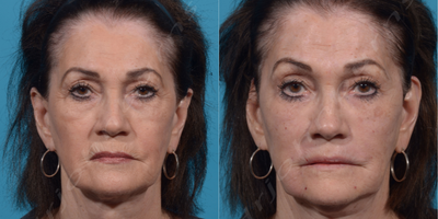 65-74 year old woman treated with Vollure - Liquid facelift:Botox: glabella, forehead, crows feetMidface: VolumaNasolabial folds/Marionette lines: VollureLip Lines: VolbellaSkin Resurfacing: Microneedling with PRP and AquaGold microbotox