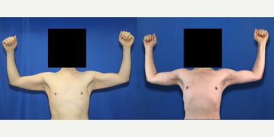 Arm Lift / Brachioplasty surgery After Major Weight Loss Removes Hanging Skin - Transformation after major weight loss can leave behind loose, heavy skin that does not shrink on its own, and that is exactly why our patient came to Dr. Timothy Katzen for an arm lift, also called brachioplasty, in Beverly Hills. Our patient is a 32-year-old White male who was once morbidly obese and reached a maximum weight of 440 pounds. Through diet and exercise, he lost a massive amount of weight, reaching 154 pounds, but the skin on his upper arms remained stretched. During brachioplasty surgery under general anesthesia, Dr. Katzen carefully removed the hanging excess skin and fat from the upper arms to create a firmer, smoother, and more proportional arm contour. In simple terms, an arm lift is designed to reduce the bat wing appearance that many massive weight-loss patients struggle with after major weight loss. The incision is usually placed along the inner arm so extra tissue can be removed, and the remaining skin can be reshaped into a tighter, cleaner outline. The goal is not just smaller arms, but tighter arms that better match the patients new body. These post-weight-loss brachioplasty photos were taken 1 year after surgery and show remarkable arm-lift results, with a more athletic shape, less sagging skin, and a significant improvement in confidence. This before-and-after highlights how arm contouring surgery can complete the weight-loss journey and help patients feel more comfortable in fitted clothing and in daily life.