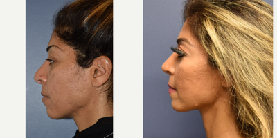 35-44 year old woman treated with Revision Rhinoplasty - 35 year old female undergoing revision rhinoplasty.