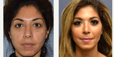 35-44 year old woman treated with Revision Rhinoplasty - 35 year old female undergoing revision rhinoplasty.
