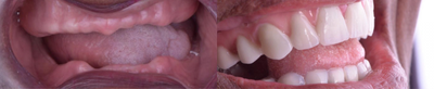 65-74 year old woman treated with All-on-4 Dental Implants - All on 4 with Porcelain overdenture, can give you the opportunity to bring back your live and show people your are still on track. Enjoy your new smile.