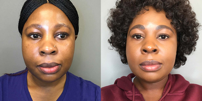 35-44 year old woman treated with Lip Reduction - I performed a Lower Lip Reduction for this patient who was unhappy with how big her lower lip was and how it appeared a little droopy in the side and front profiles. She also wanted to reduce how much of the pink part of her lower lip showed and while I explained that this procedure may not be able to entirely do that, the final result shows that we have achieved a much subtler shade for her lips. This procedure was performed under local anaesthetic and she is extremely happy with her results!