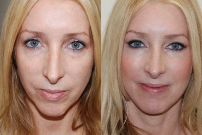 Silikon-1000 injections to cheeks and lower eyelid grooves. Botox. - 
	These photos demonstrate non-surgical facial rejuvenation with Silikon-1000, an off-label filler for permanent results. Several treatments were performed and volume was replaced in her lower eyelid grooves and cheeks. She also had Botox to her glabella and crow's feet.&nbsp;