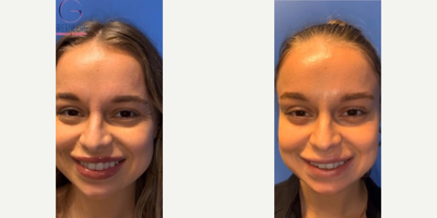 Woman treated with Botox - Woman treated with Botox to tighten and smooth out skin for an overall glow