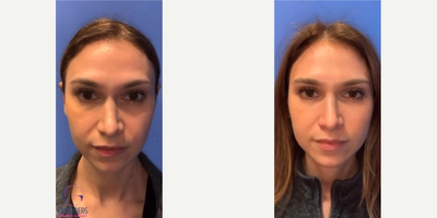 Woman treated with Botox - Woman treated with Botox