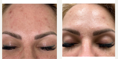 35-44 year old woman treated with Vampire Facial - Vampire facial to treat acne scars, tighten skin and improve skin texture