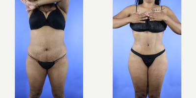 25-34 year old woman treated with Brazilian Butt Lift - Patient is 3 months post liposuction 360 and Brazilian butt lift. She looks amazing!