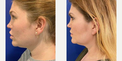Woman treated with Sofwave - Woman treated with Sofwave.