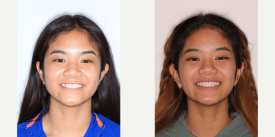 Woman treated with Braces - Woman treated with Braces.