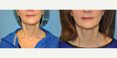 55-64 year old woman treated with ThermiTight - 64 year old female underwent ThermiTight surgery under local anesthesia