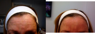 62 Year old Female Treated for Deep Lines on the Forehead with Pellev - After single treatment with Pellev to forehead