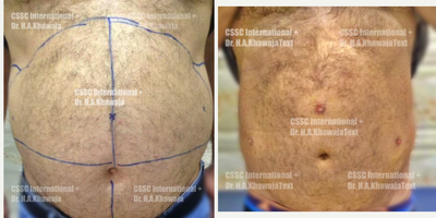 Liposuction - Liposuction of upper and lower abdomen and flanks under tumescent local anaesthesia.