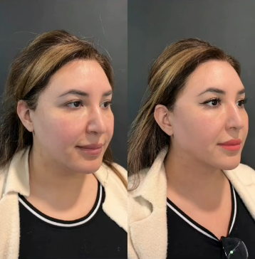 Woman treated with Cheek Lift - Woman treated with Cheek Lift