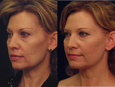 Yag Laser Skin Tightening - 	Laser Skin Tightening