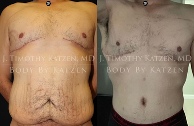 Man treated with Body Lift - Man treated with Body Lift