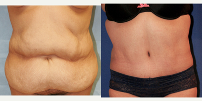 45-54 year old woman treated with Tummy Tuck - 52 year old female, mother of 4.