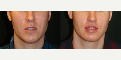 25-34 year old man treated with Jaw Reduction - This chap underwent a bony chin reduction to shorten his chin for both aesthetic and rejuvenative purposes, as well as refinement of his neck region with 360 micro-liposuction. Additionally he had Dr Haworth's lip reshaping surgery including an upper lip, medialized corner lip and lower lip lifts. Fat transfer completed the refinement.