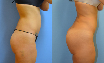 25-34 year old woman treated with Brazilian Butt Lift Revision - Nice improvement with BBL