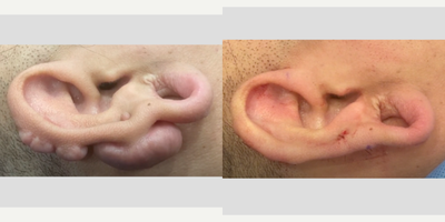 25-34 year old woman treated with Scar Removal - Patient came into the office presenting with multiple keloid scars along the outer cartilage of her ear. We surgically removed these keloids. She will be following up with additional visits to the office for triamcinolone injections to ensure the keloids do not return.