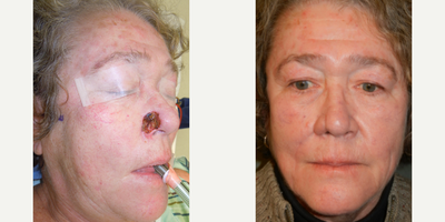 55-64 year old woman treated with Mohs Surgery - Repair of nasal defect with cheek flap