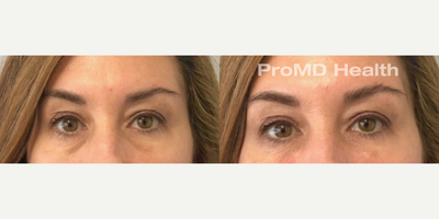 Woman treated with Dermal Fillers, Hyaluronidase, Sculptra - Woman treated with Dermal Fillers, Hyaluronidase, Sculptra