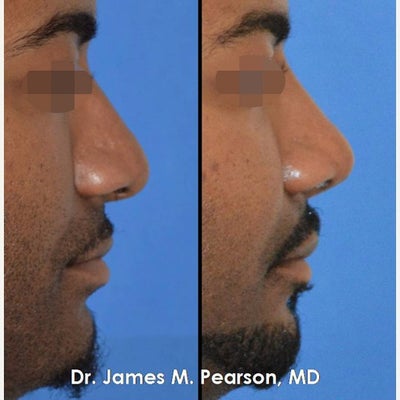 Rhinoplasty / Nose Reshaping in African American Male - Rhinoplasty / Nose Reshaping in African American Male by Dr. Pearson