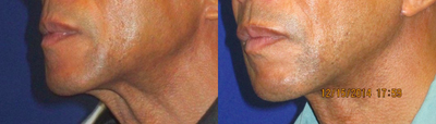 45-54 year old man treated with Mini Lift - My patient was not happy with his heavy neck banding making him look older. He underwent a mini lift.