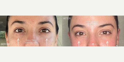 Woman treated with PlasmaPen - Woman treated with PlasmaPen