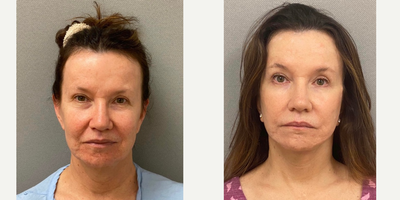 58 year old woman treated with Facelift/Neck Lift/Lower Facelift - 58 yo s/o facelift/ necklift performed under local anesthesia with sedation in our on site AAAA certified operating suite