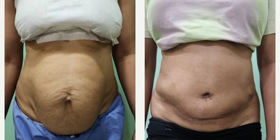 25-34 year old woman treated with Tummy Tuck, Diastasis Recti Repair - 26 year old woman who  Tummy tuck and diastasis Recti repair