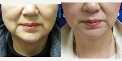 women treated with MACS Facelift - face lift