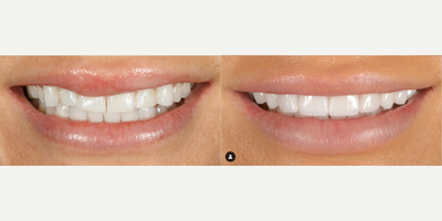 Woman treated with Smile Makeover, Porcelain Veneers, Dental Crown - Before her smile makeover, this patients teeth were worn and short. She wanted a bit more length, but still liked the shape of her teeth. A more rounded shape wouldve been a bit too different than what she had before, so we subtly enhanced what she had before and ended up with a great result that still makes her look like herself!Shade: BL2/BL1 HT