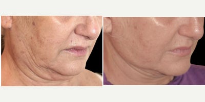 65-74 year old woman treated with MyEllevate, Nonsurgical Neck Lift - 67 year old female 3 weeks following the MyEllevate Plus procedure with placement of a permanent suture to enhance structural neck definition through a series of tiny punctures immediately below the lower edge of the jawline and excision of skin behind the ear.