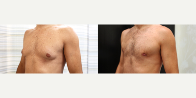 43 year old man treated with Gynecomastia Surgery - This male patient aged 43 was treated with gynecomastia surgery, where a mastectomy is used to remove enlarged male breast tissue. The after photo was taken 2 months post-surgery.
