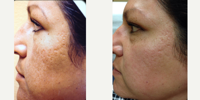 45-54 year old woman treated with eMatrix - This patient suffered from hyperpigmentation as well as acne scars. We treated her with a combination of sublative Rf (ematrix) as well as Fotofacial and chemical peels. She maintains her excellent results with a maintenance treatment every 3 months.