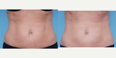 35-44 year old woman treated with Liposculpture - This patient had one CoolSculpting treatment done to her abdomen and flanks (love handles.) The photo is pictured 12 weeks after her treatment. This holistic approach to body contouring will give you the sculpted shape you want.
