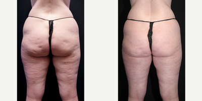 35-44 year old woman treated with Cellulaze - 40 year old female received Cellulaze to the thighs and buttocks; photos depict the patient's results 1 month post-op.