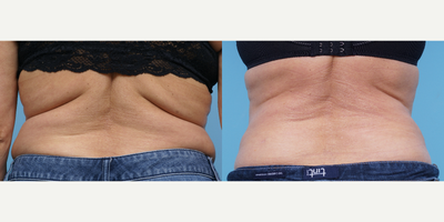 55-64 year old woman treated with CoolSculpting - This patient had CoolSculpting done to her flanks (love handles) and bra line area. She had 1 treatment done which was photographed 12 weeks after her treatment. While some patients may see results as early as 3 weeks after their first treatment, the most dramatic results are usually seen between 1 and 3 months following treatment.